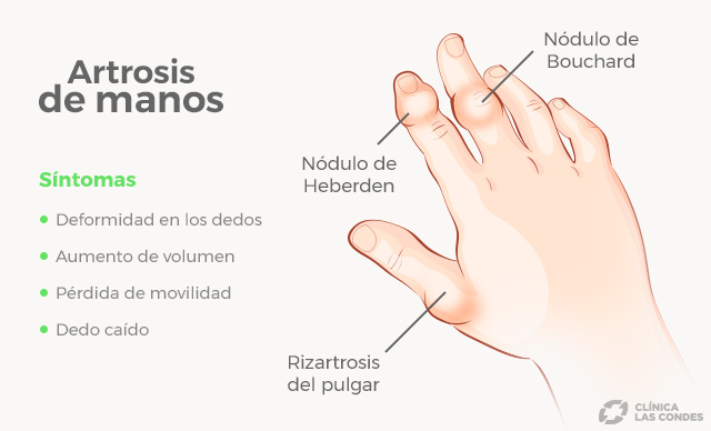 Artrosis en los dedos de las manos