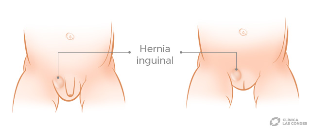 Tipos de hernia y su tratamiento