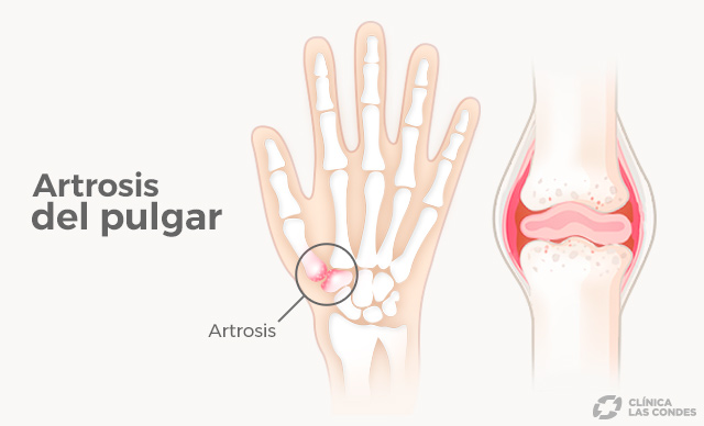 Rizartrosis o artrosis del pulgar. Síntomas, tratamiento y recuperación