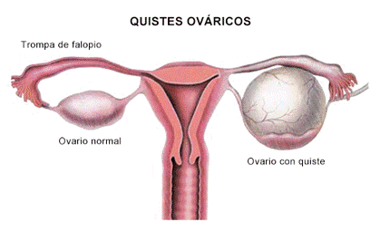 ooforectomia-extirpacion-ovario